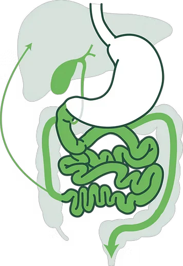 Diagram of bile acid malabsorption: excess bile acid reaches the colon, driving secretion.